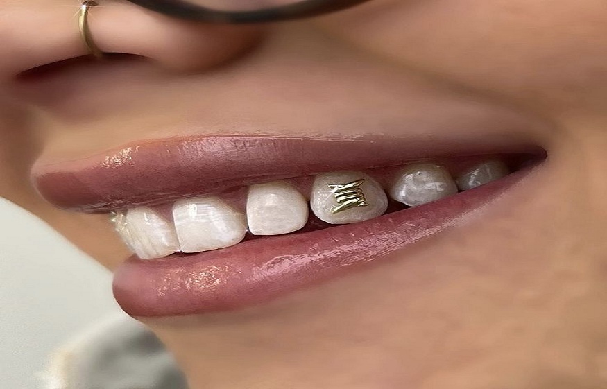 tooth gem technician